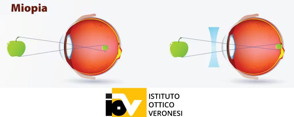 come rallentare la miopia istituto ottico veronesi bologna