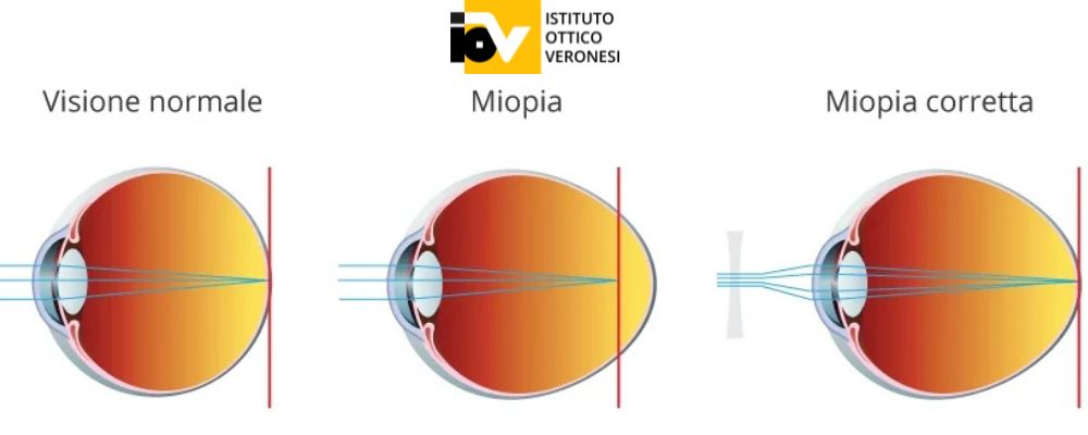 come rallentare la miopia istituto ottico veronesi bologna